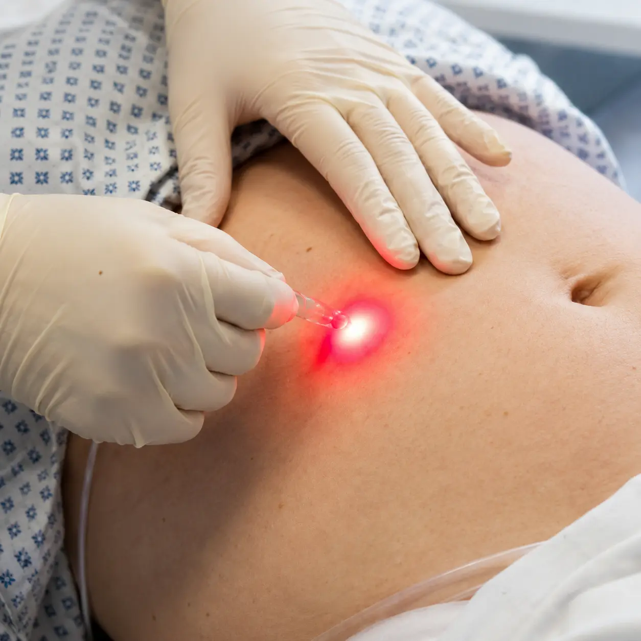 Endolift Dubai | Laser Skin Tightening | Harley Poly Clinic